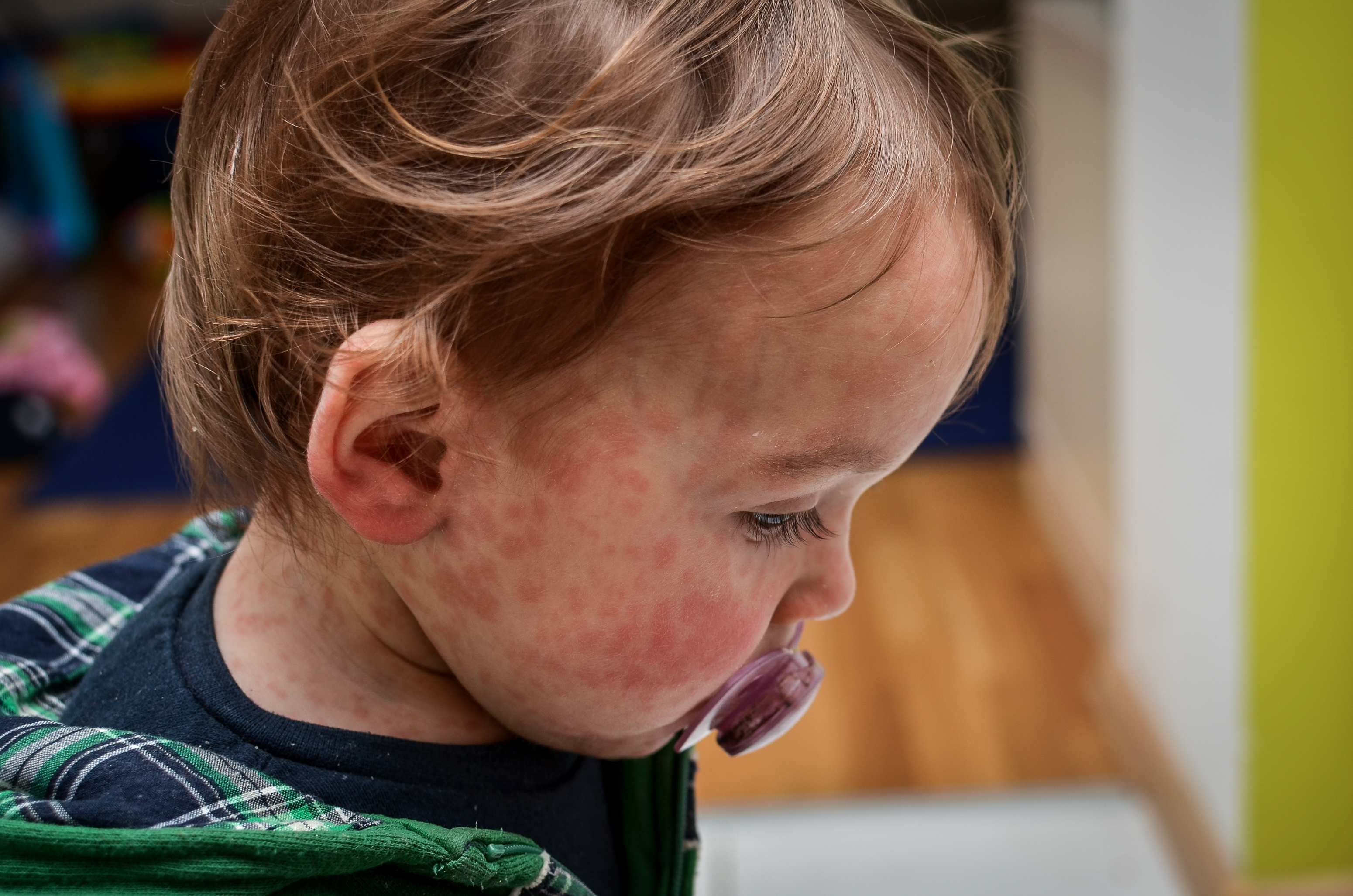 Laat je kinderen vaccineren tegen mazelen